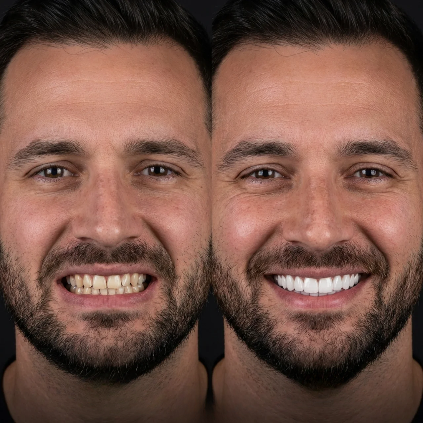 Éclatis™ Veneers