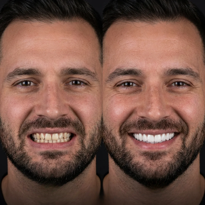 Éclatis™ Veneers