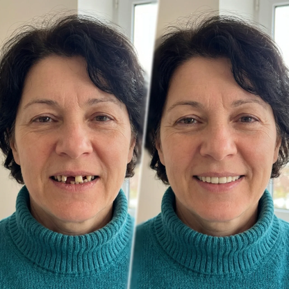 Éclatis™ Veneers