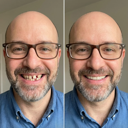 Éclatis™ Veneers